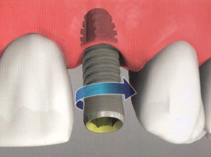 upper posterior problems affect implant treatment