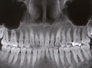 implant treatment digital 3d imaging ICAT