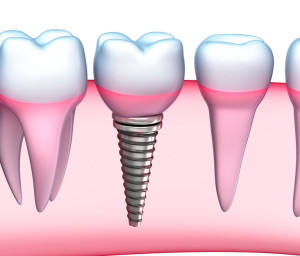 Dental implants atlanta