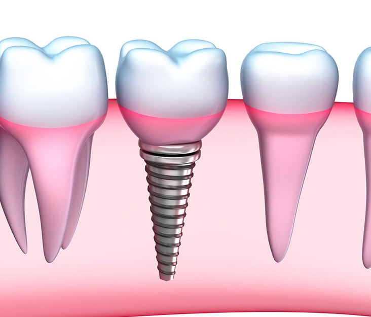 Dental Implants: Know the Risks
