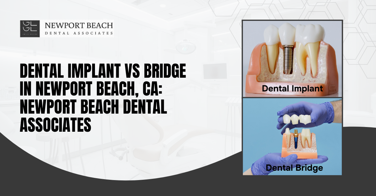 Dental Implant vs Bridge
